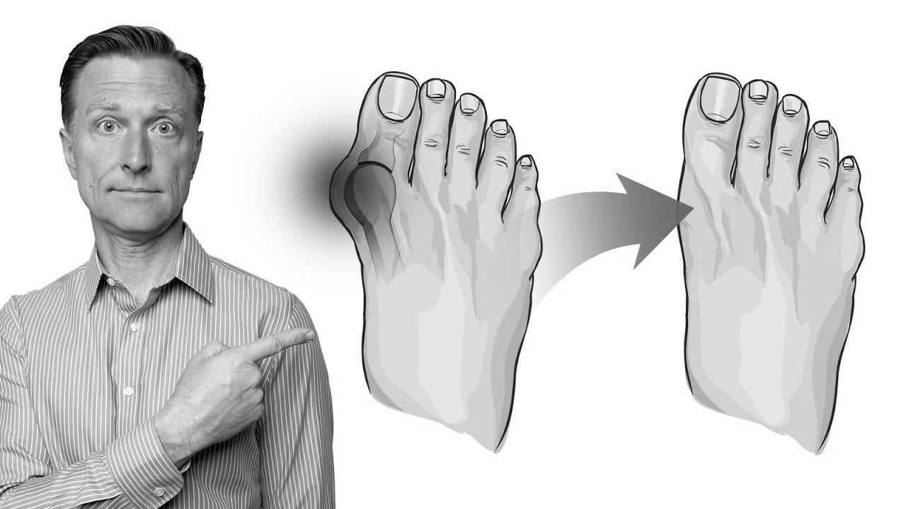 How one can Fix Bunions in 3 Steps