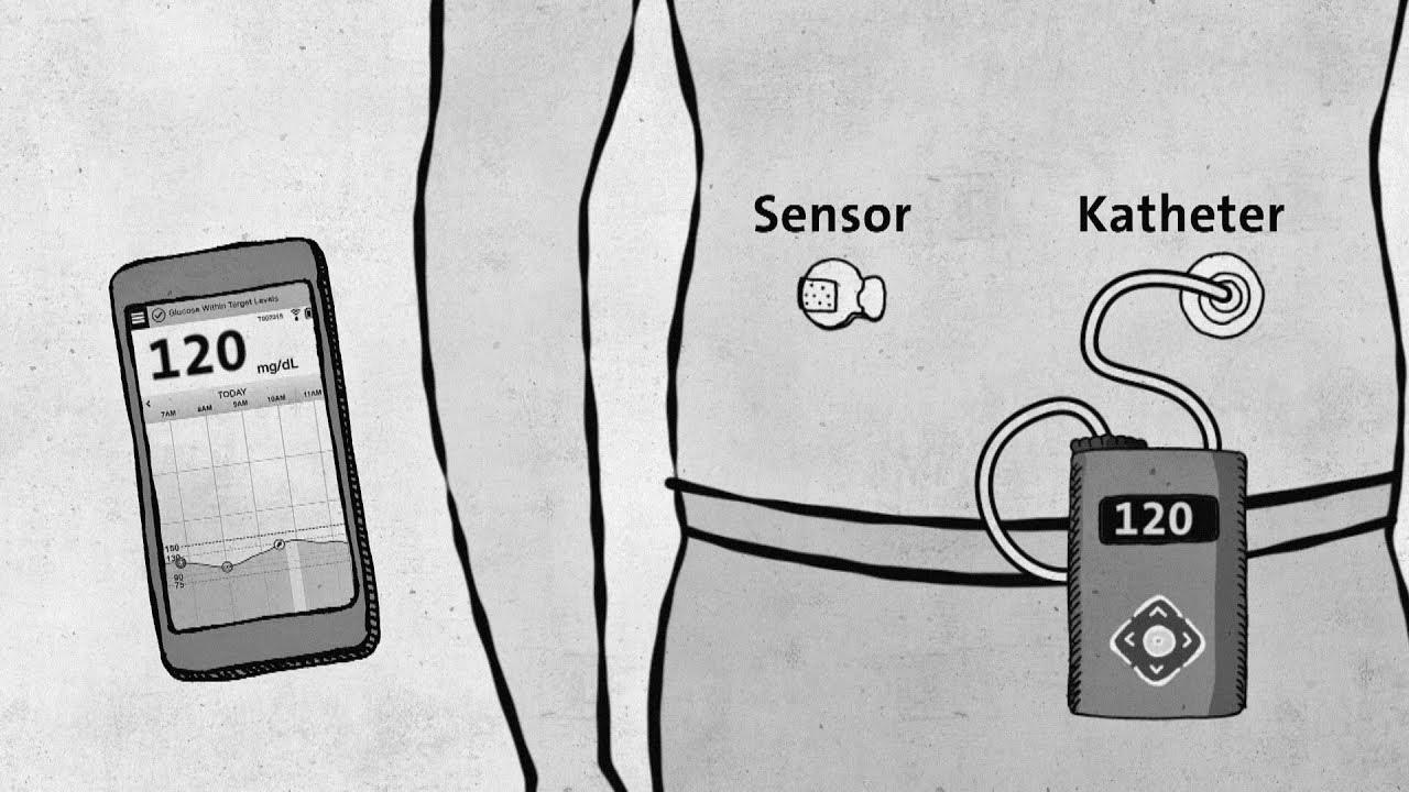 Sort 1 diabetes – fashionable technology with out approval – good to know